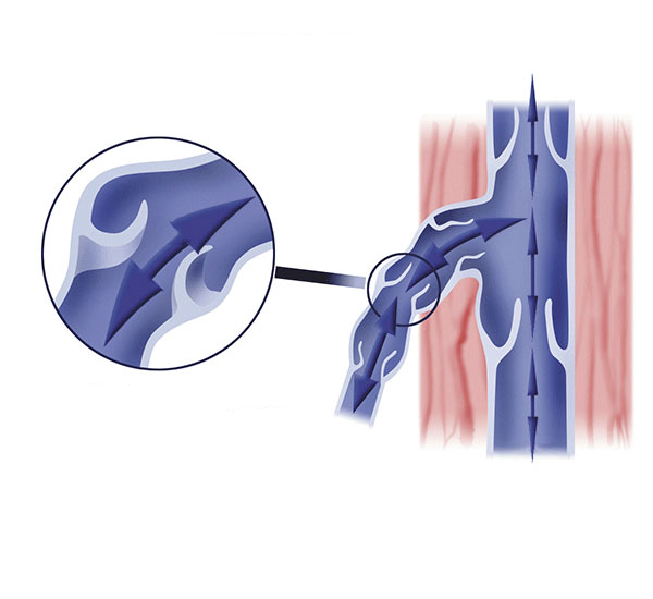 varicose veins without surgery varicose veins without surgery